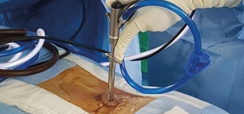 cirurgia endoscópica da coluna