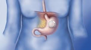 Cirurgia para colocação de balão gástrico tem maior procura na pandemia